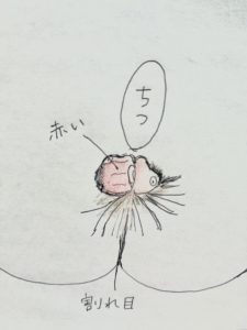 術後の肛門のイラスト